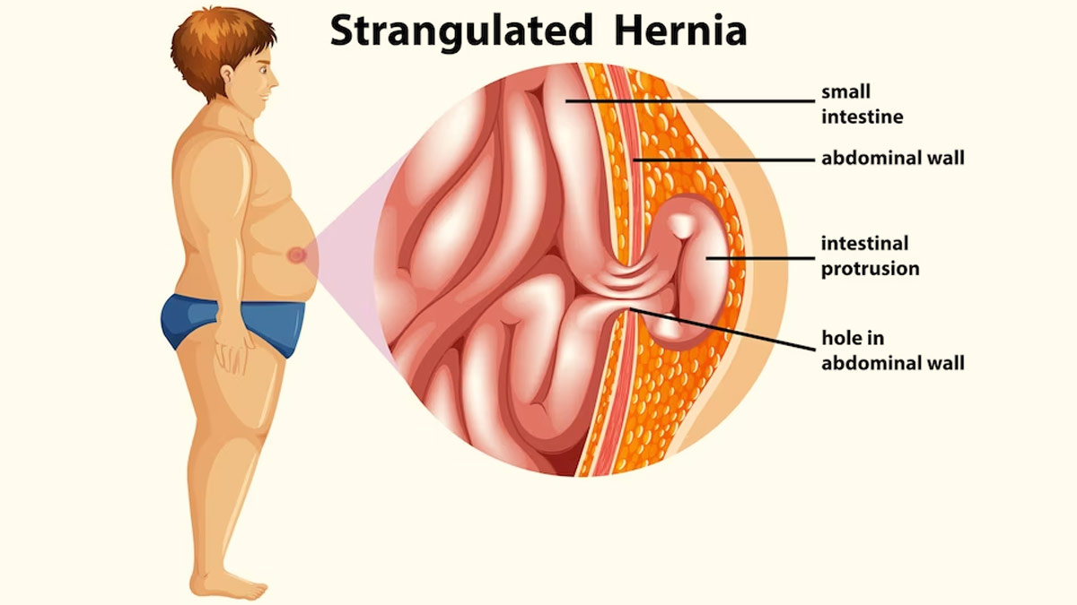 Is Bloating A Sign Of Hernia? Read To Know