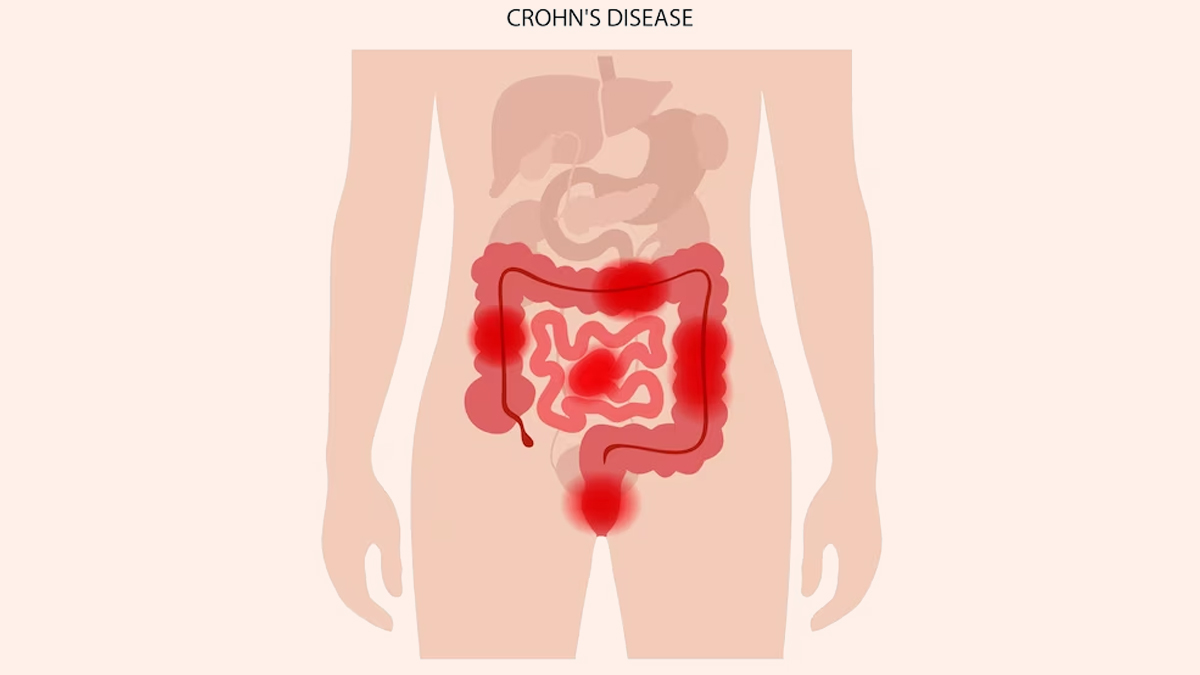 Ulcerative Colitis: Expert Explains The Disease And Lists Dietary Measures  To Follow