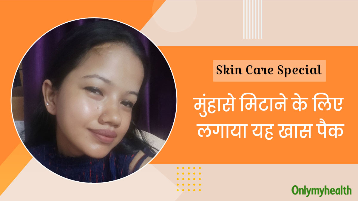 चेहरे पर हो गए थे कील-मुंहासे, फिर लगाया मुल्तानी मिट्टी और गुलाब जल का पेस्ट, एक हफ्ते में मिला अच्छा रिजल्ट
