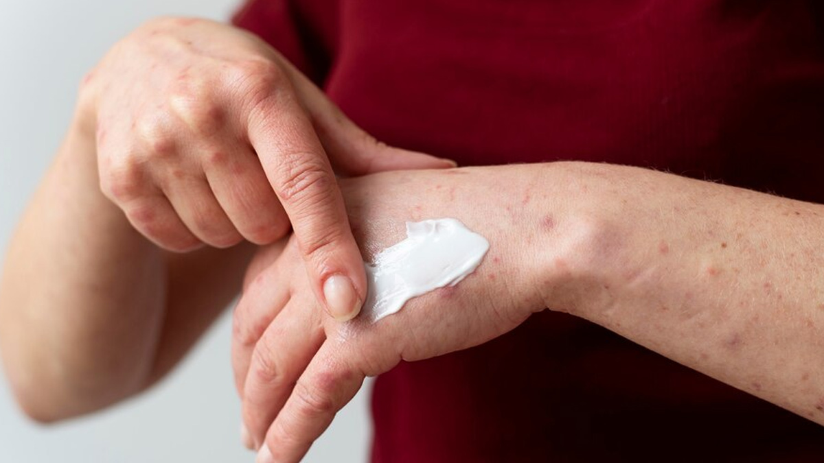 Diwali 2023 Expert Shares First Aid Tips For Burns From Crackers