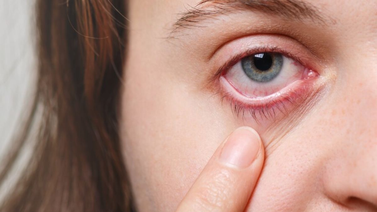 What is Ptosis: क्या है पीटोसिस बीमारी जिसमें पलकें जाती हैं झुक, जानें लक्षण और बचाव