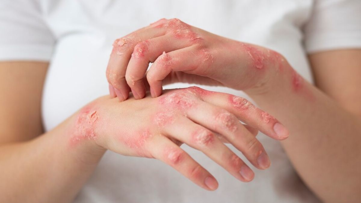 Can Ringworm Spread From Person To Person