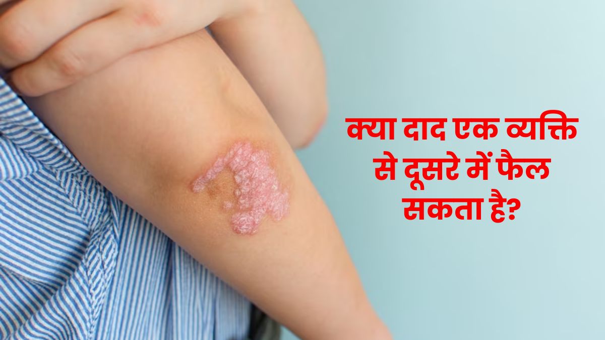 क्या दाद (रिंगवर्म) एक व्यक्ति से दूसरे में फैल सकता है? जानें क्या कहते हैं डॉक्टर