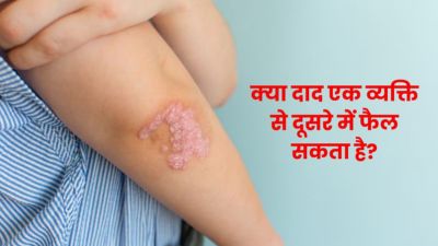 क्या दाद (रिंगवर्म) एक व्यक्ति से दूसरे में फैल सकता है? जानें क्या कहते हैं डॉक्टर