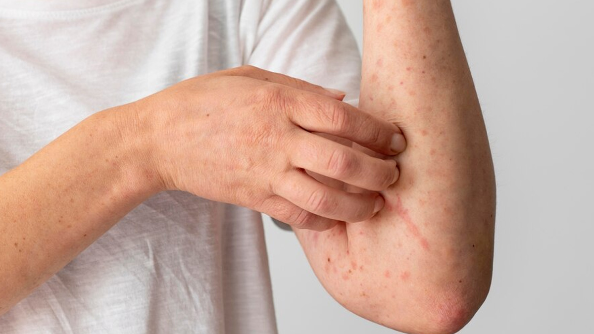 winter rash in hindi