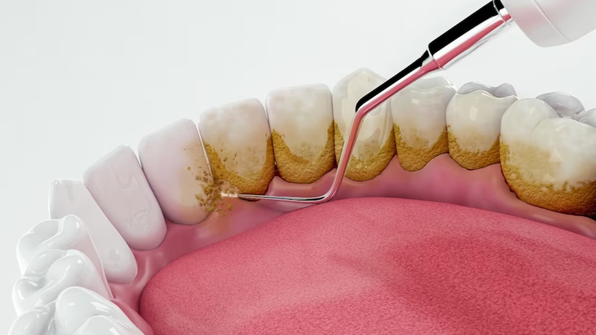 Causes Of Dental Plaque In Hindi