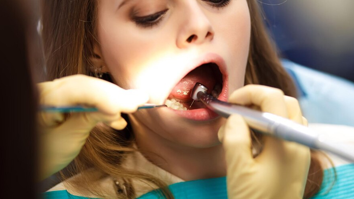 दांतों में प्लाक (पीली परत) जमने के हो सकते हैं ये कारण, डॉक्टर से जानें क्या है इसका इलाज