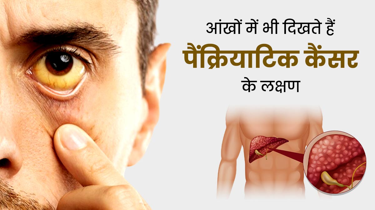पैंक्रियाटिक कैंसर की शुरुआत में आंखों में दिखते हैं ये लक्षण, जानें बचाव