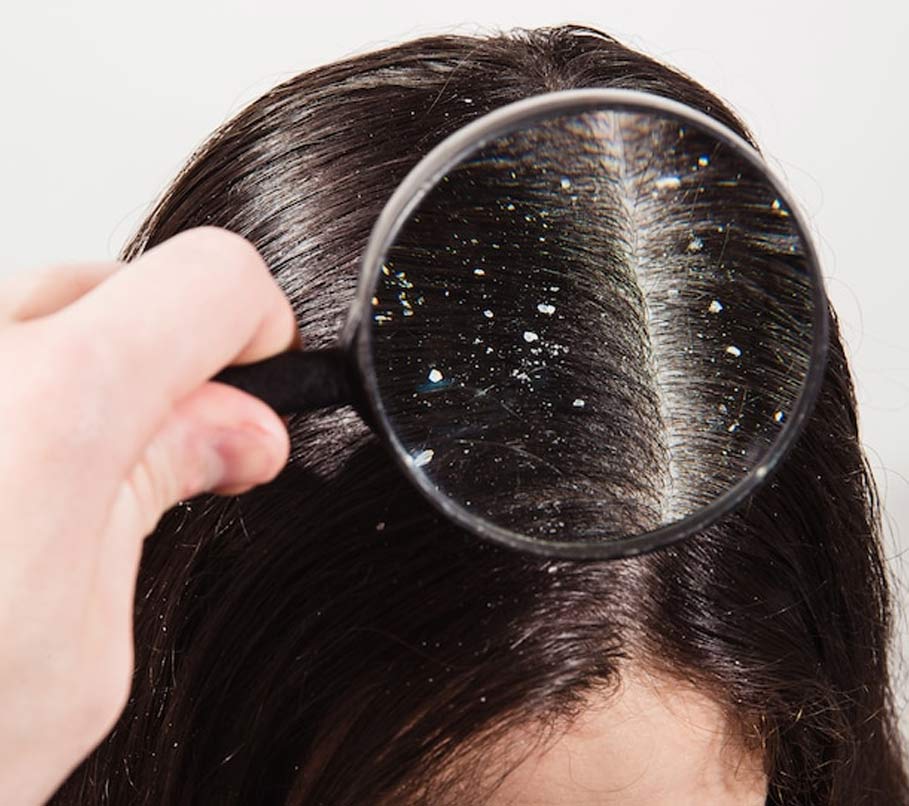 tips to manage sebum to prevent dandruff in hindi