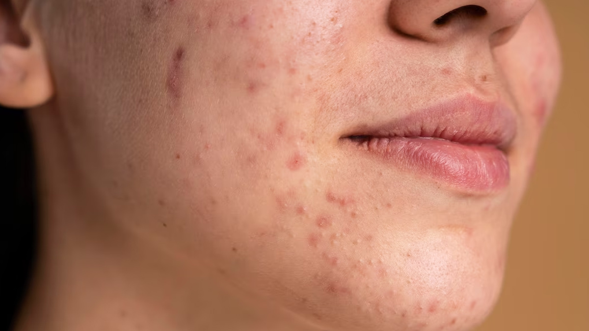 acne-scars
