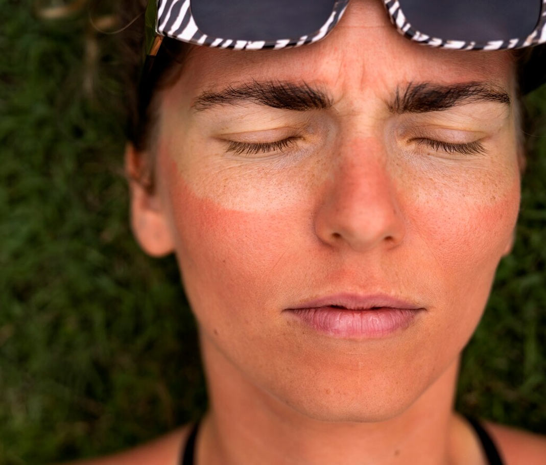 Foods That Protect Skin From Sun Damage