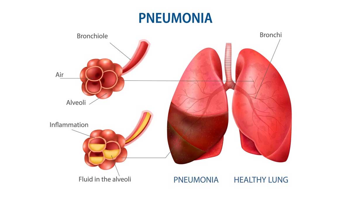 Pneumonia Cases In China Can Spillover In Other Countries