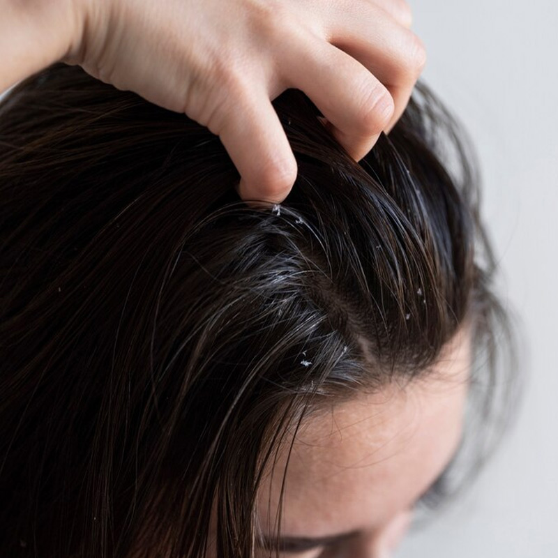 dandruff