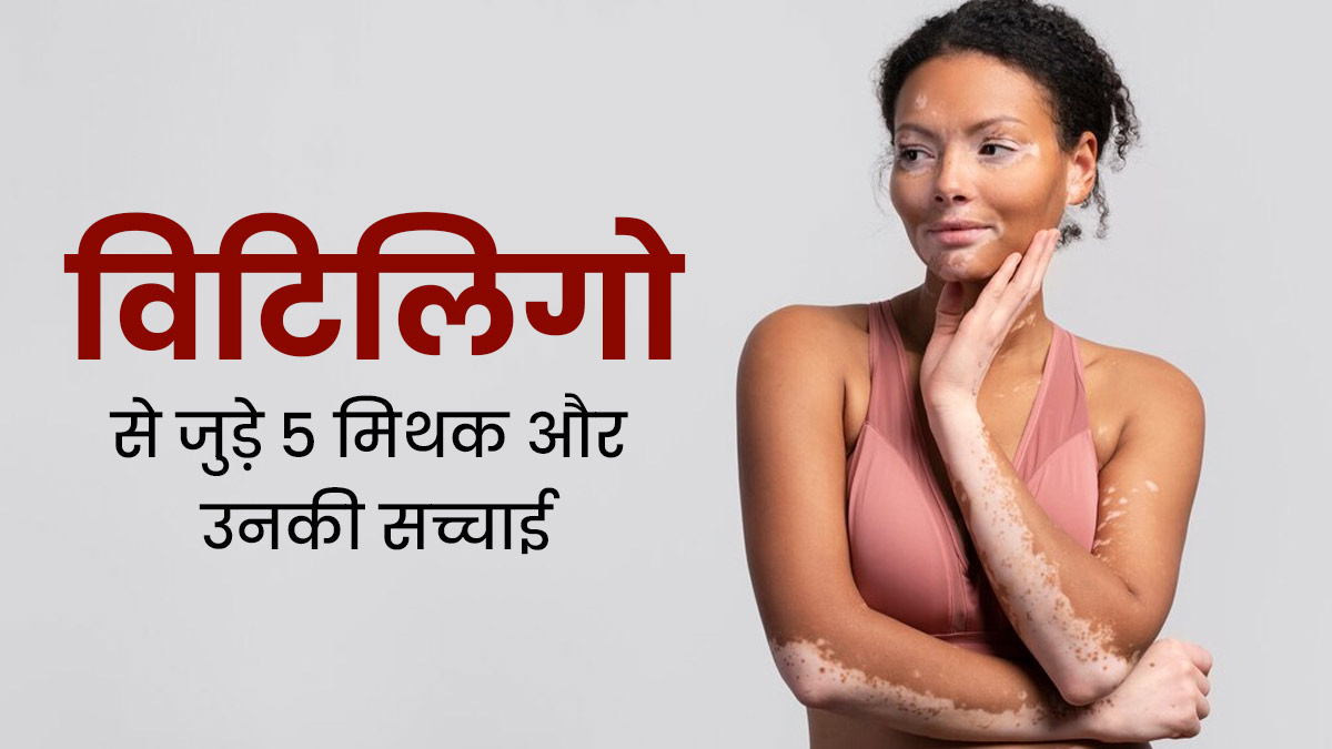 छूने से फैल सकती है सफेद दाग की समस्या! जानें विटिलिगो से जुड़े ऐसे ही 5 मिथकों की सच्चाई 