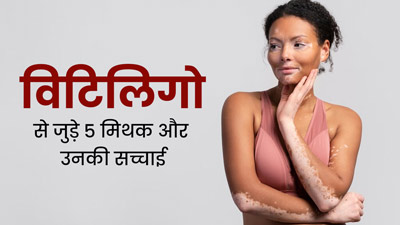 छूने से फैल सकती है सफेद दाग की समस्या! जानें विटिलिगो से जुड़े ऐसे ही 5 मिथकों की सच्चाई 