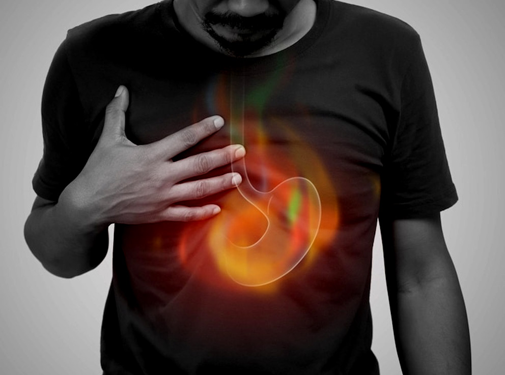 acid reflux