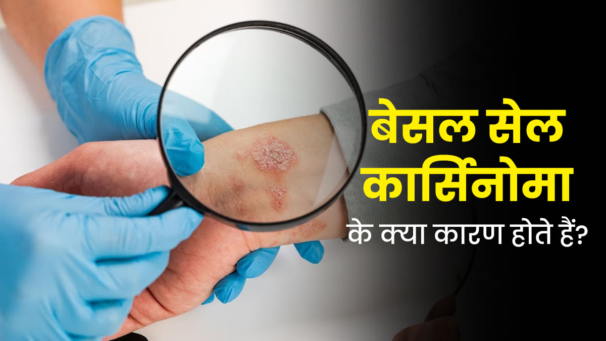 बेसल सेल कार्सिनोमा (स्किन कैंसर) क्यों होता है? जानें इसके कारण और इलाज