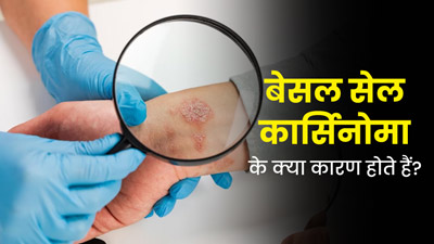 बेसल सेल कार्सिनोमा (स्किन कैंसर) क्यों होता है? जानें इसके कारण और इलाज