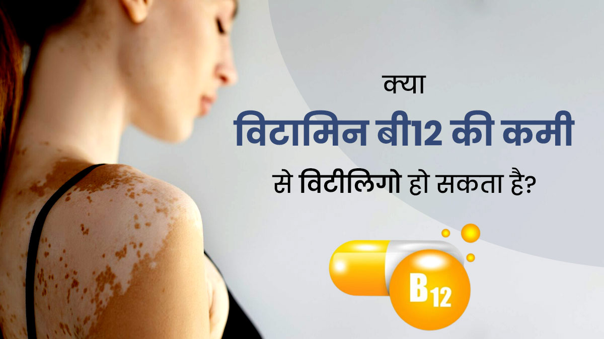 विटामिन बी12 की कमी बन सकता है विटिलिगो का कारण, इस तरह से करें इलाज