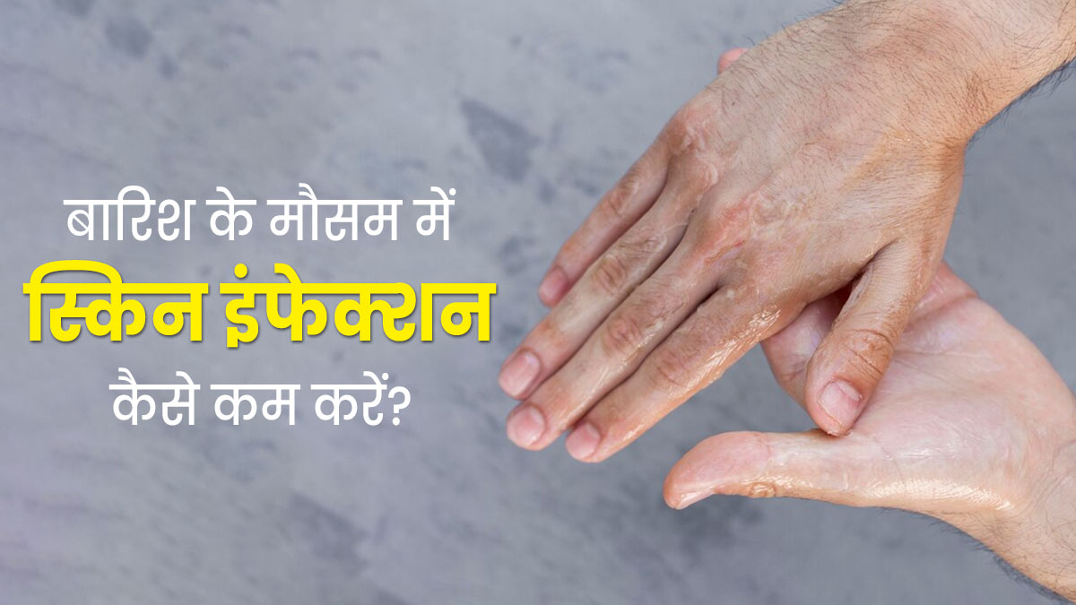 बारिश के मौसम में स्किन इंफेक्शन से बचने के लिए अपनाएं ये 5 टिप्स, त्वचा रहेगी सुरक्षित 