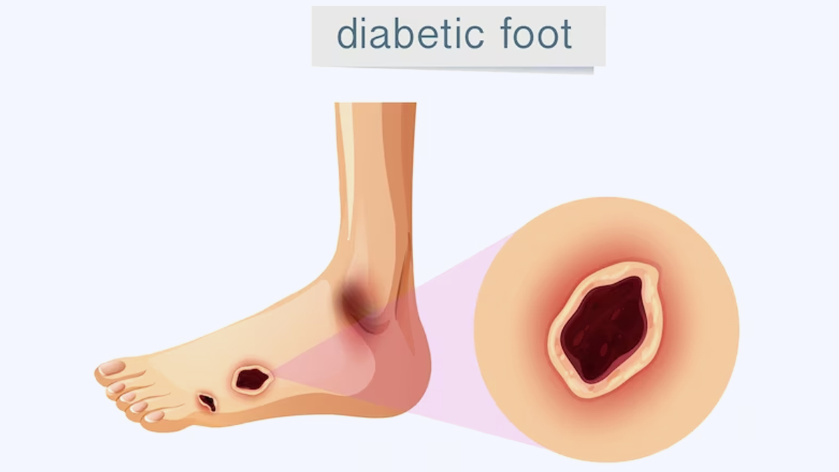 Stem Cell Therapy For Diabetic Foot Ulcers: Doctor Shares The Potential 