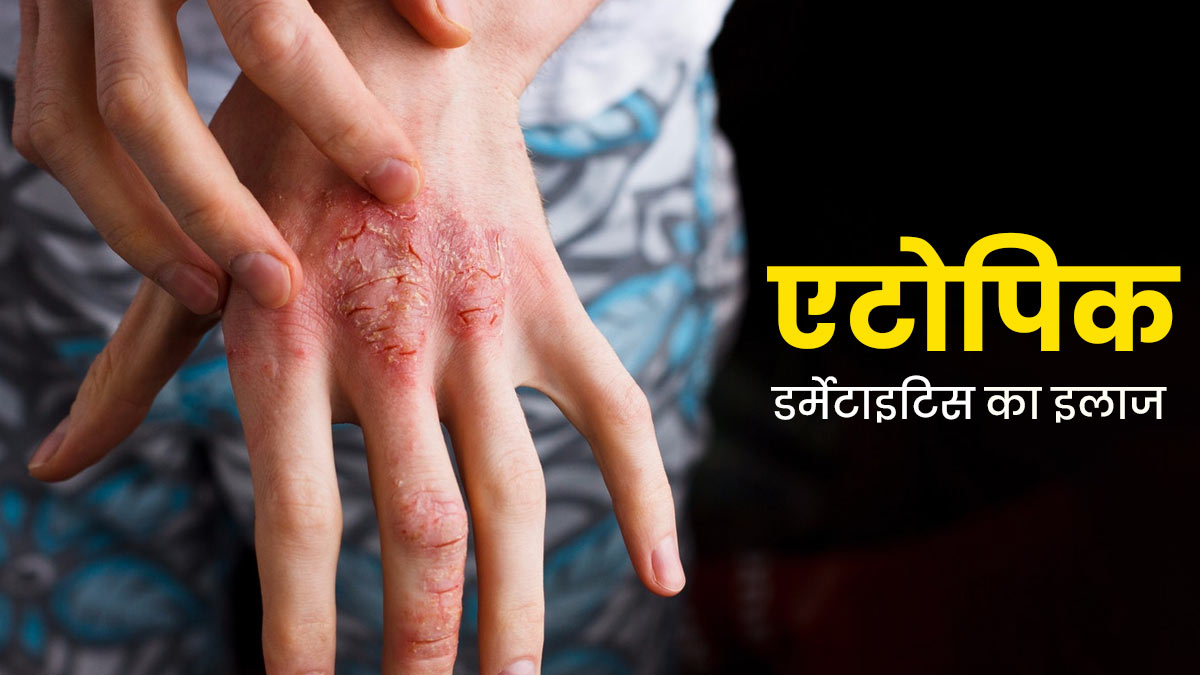 Atopic Dermatitis: त्वचा पर हो रही है सूजन और खुजली? तो जानें कैसे किया जाता है एटोपिक डर्मेटाइटिस का इलाज