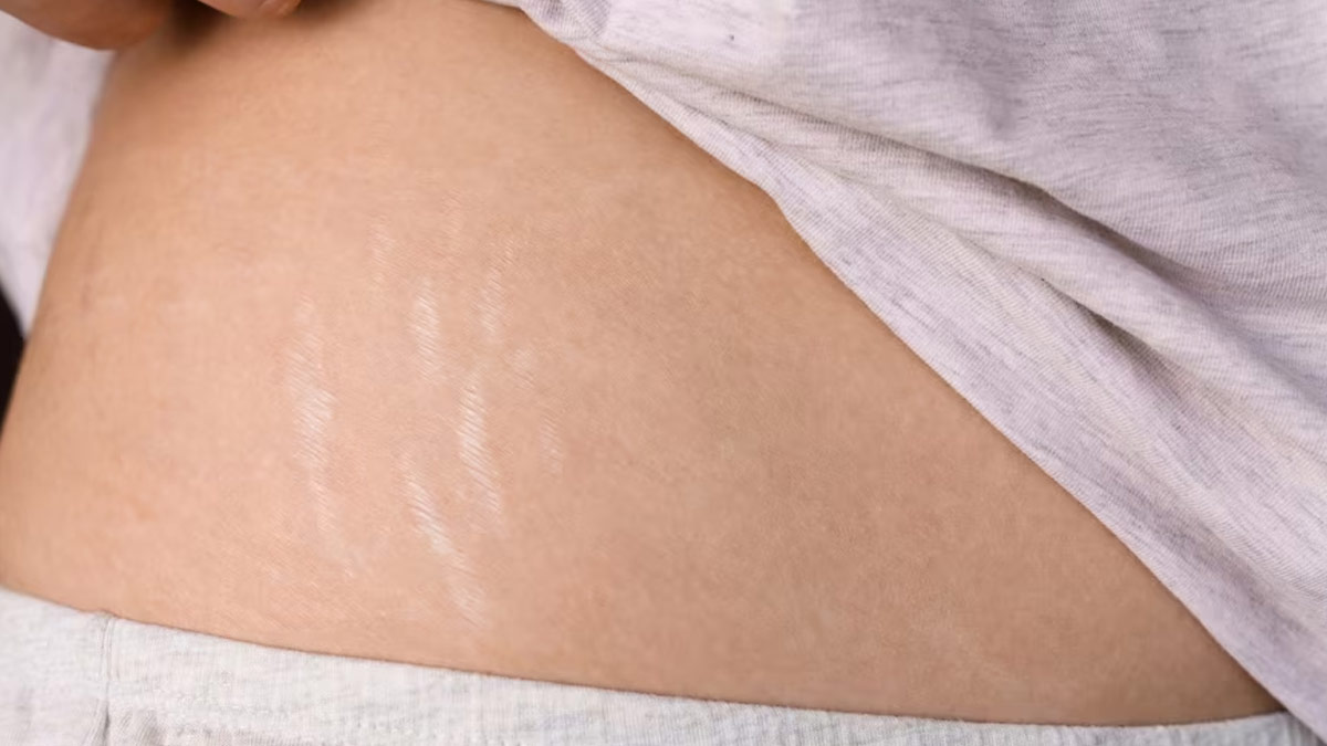 Stretch marks: What Are The Reasons Behind It and Can It Be Removed?
