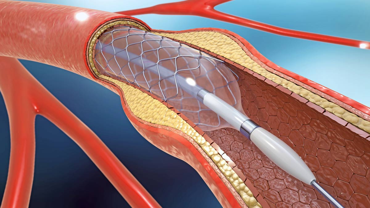 angioplasty benefits in heart patient