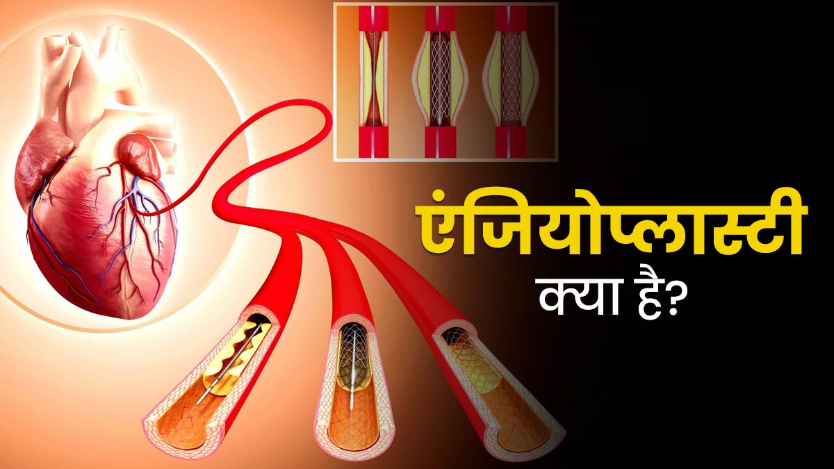 एंजियोप्लास्टी क्या है? जानें हृदय रोगियों को कब पड़ती है इसकी जरूरत