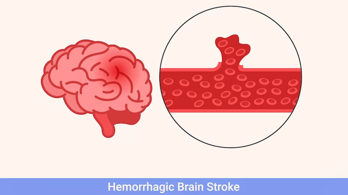 Blood Clot In The Brain Expert Explains Intracranial Haemorrhage, Its Symptoms, And Treatment