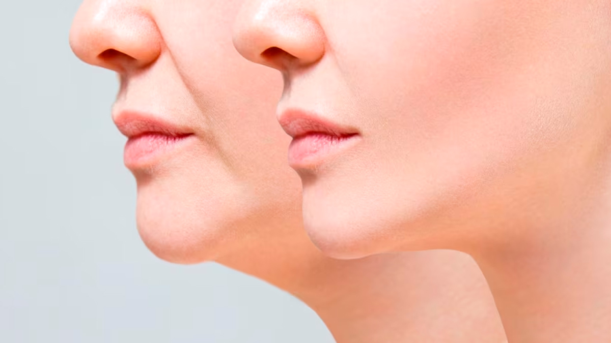 hormones-could-be-causing-your-chin-acne-here-s-how-to-get-rid-of-them