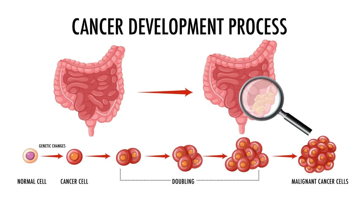 Miracle Drug For Colorectal Cancer: UK Woman Declared Cancer Free After ...