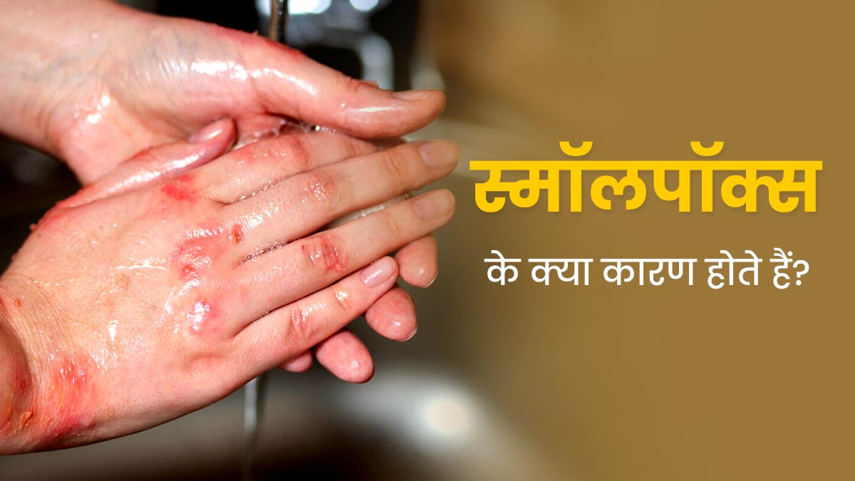 स्मॉलपॉक्स के क्या कारण होते हैं? डॉक्टर से जानें इसके लक्षण और इलाज 