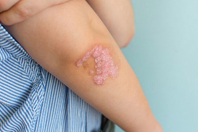 papaya juice for Ringworm