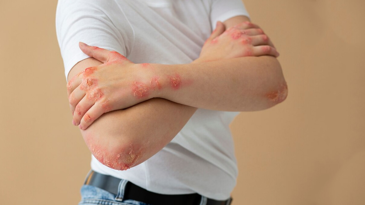 Psoriasis Diet Recommendations: Expert Lists Foods To Eat And Avoid