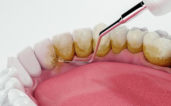 Tooth Damage Due To Severe Decay