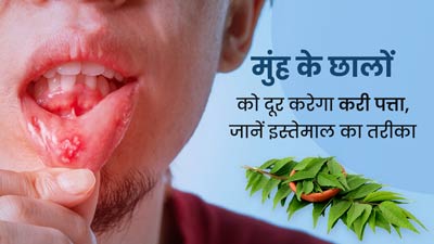 मुंह के छालों को ठीक करने में कारगर है करी पत्ता, एक्सपर्ट से जानें इस्तेमाल का सही तरीका