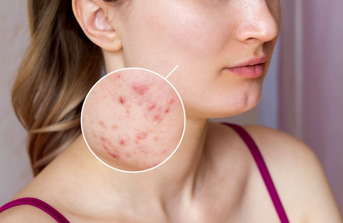 skin infection in hindi