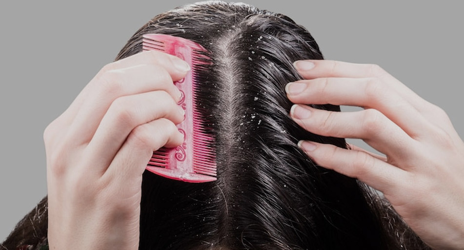 causes of dandruff