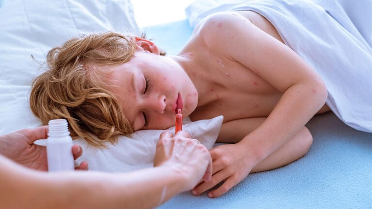 Why Does Chickenpox Only Happen Once In A Lifetime