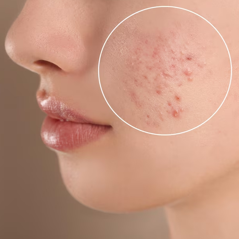 Vitamins to prevent acne