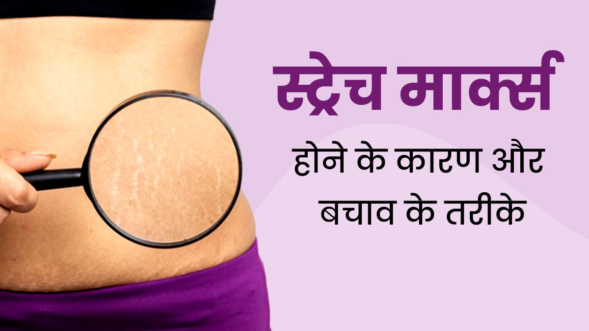स्ट्रेच मार्क्स से हैं परेशान? तो फॉलो करें एक्सपर्ट के बताए ये टिप्स 