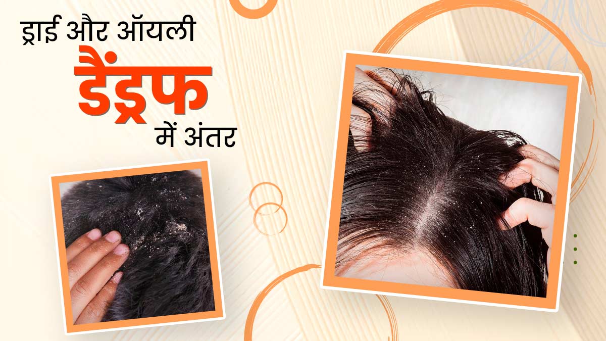 ड्राई और ऑयली डैंड्रफ में क्या अंतर होता है? जानें इससे छुटकारा पाने के उपाय