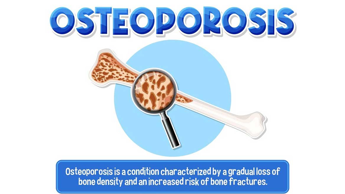 World Osteoporosis Day 2023 Expert Explains Dietary Measures Important For Strengthening Bones