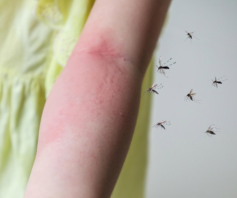 skeeter syndrome causes in hindi