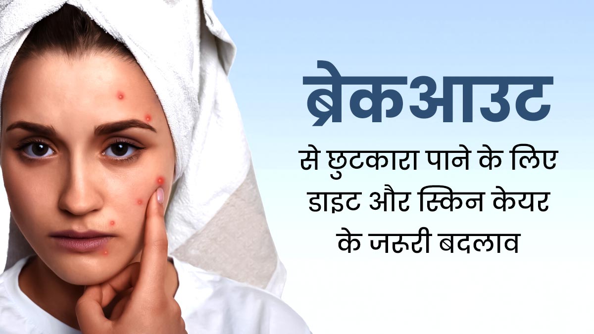 मुंहासों या ब्रेकआउट से छुटकारा पाने के लिए डाइट और स्किन केयर रूटीन में करें ये बदलाव, जल्द दिखेगा असर