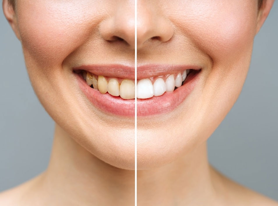 Teeth Whitening