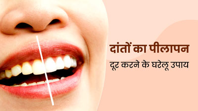 पीले दांतों को चमकाने के लिए अपनाएं ये 5 घरेलू उपाय, मसूड़े भी बनेंगे मजबूत