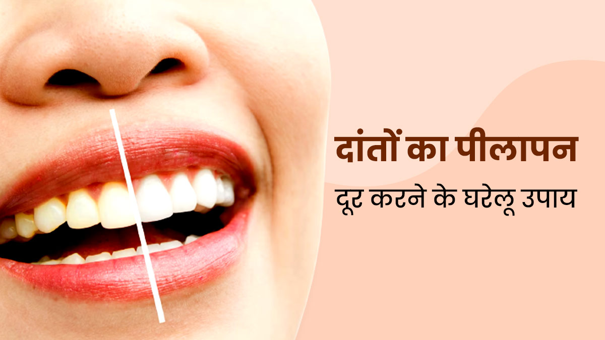 पीले दांतों को चमकाने के लिए अपनाएं ये 5 घरेलू उपाय, मसूड़े भी बनेंगे मजबूत