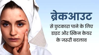 मुंहासों या ब्रेकआउट से छुटकारा पाने के लिए डाइट और स्किन केयर रूटीन में करें ये बदलाव, जल्द दिखेगा असर